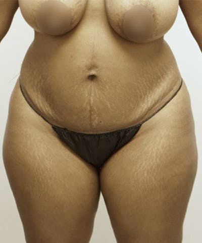 Tummy Tuck Before & After Gallery - Patient 93898969 - Image 1