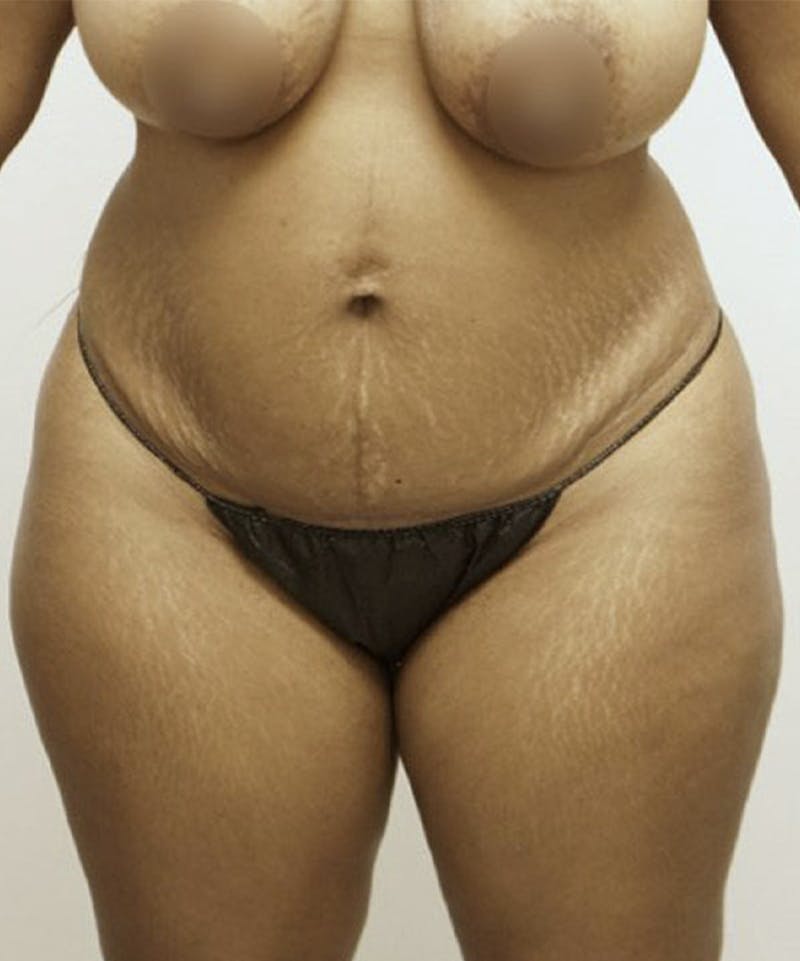 Tummy Tuck Before & After Gallery - Patient 93898969 - Image 1