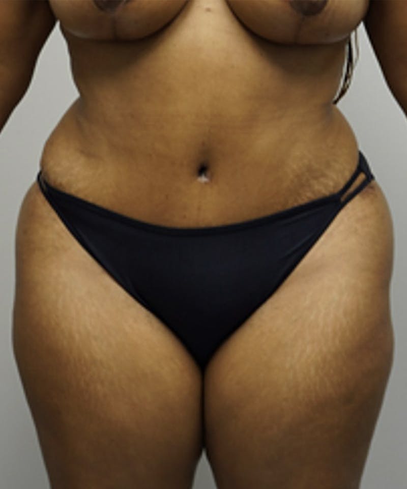 Tummy Tuck Before & After Gallery - Patient 93898969 - Image 2