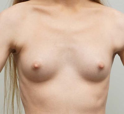 Breast Augmentation Before & After Gallery - Patient 93898988 - Image 1