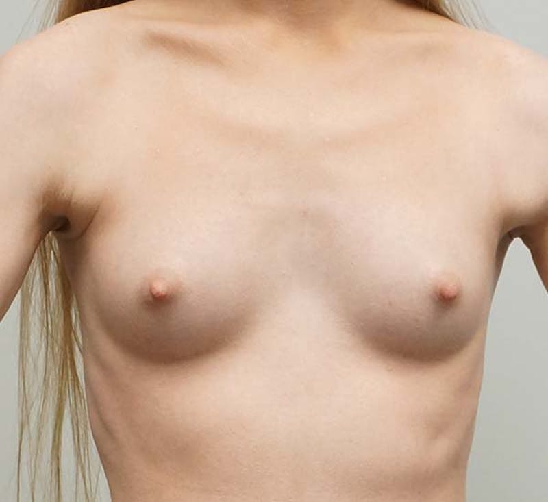 Breast Augmentation Before & After Gallery - Patient 93898988 - Image 1
