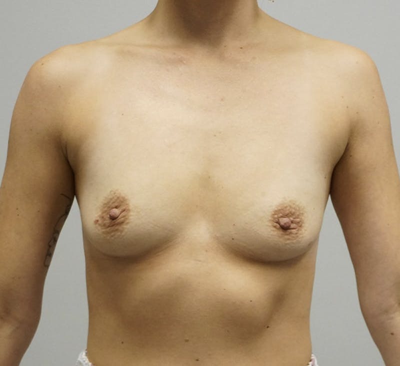 Breast Augmentation Before & After Gallery - Patient 93899111 - Image 1
