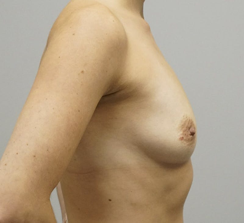 Breast Augmentation Before & After Gallery - Patient 93899111 - Image 3