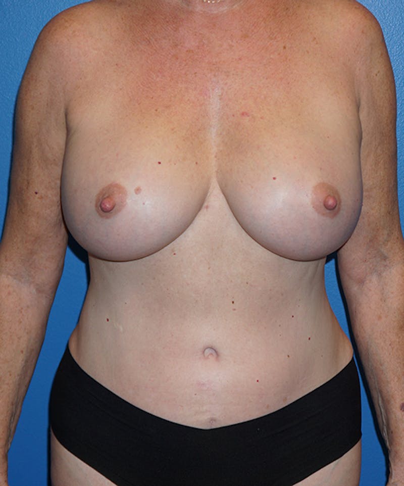 Tummy Tuck Before & After Gallery - Patient 93899191 - Image 2