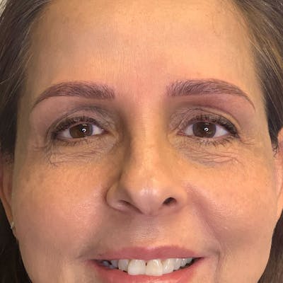 3D Microblading/ Henna Brows Before & After Gallery - Patient 93899188 - Image 2