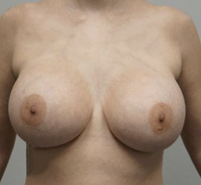 Breast Augmentation Before & After Gallery - Patient 93899231 - Image 2