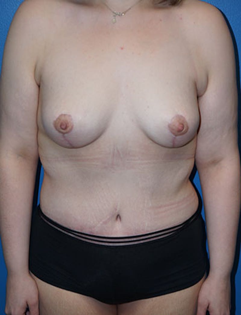 Tummy Tuck Before & After Gallery - Patient 93899234 - Image 2