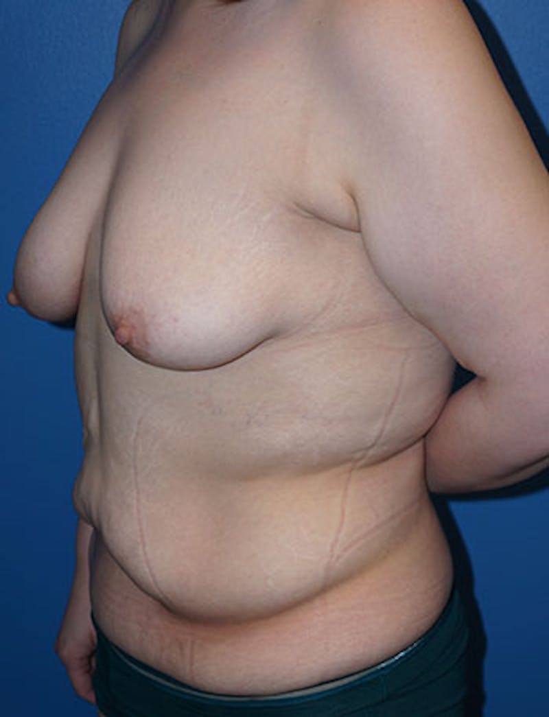 Tummy Tuck Before & After Gallery - Patient 93899234 - Image 3