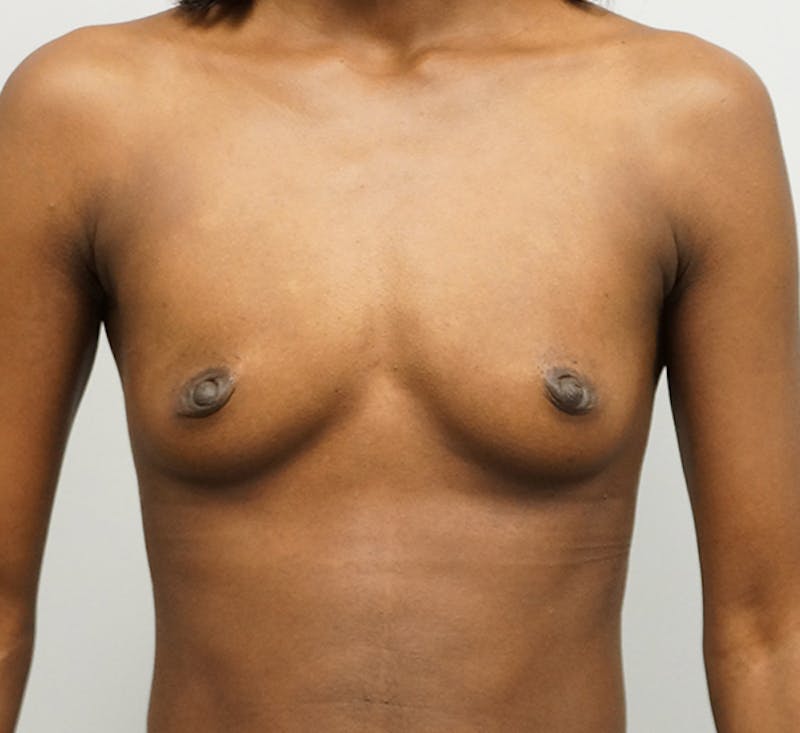 Breast Augmentation Before & After Gallery - Patient 93899233 - Image 1
