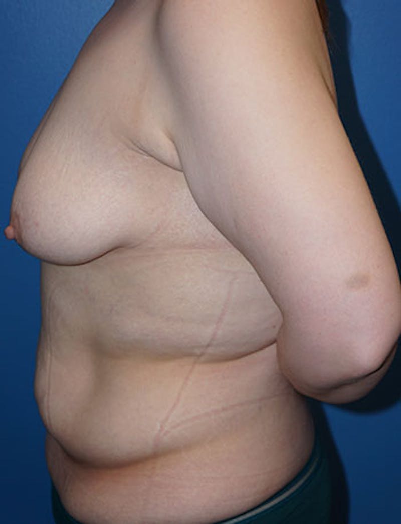 Tummy Tuck Before & After Gallery - Patient 93899234 - Image 5