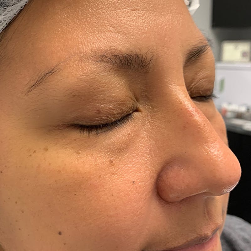 3D Microblading/ Henna Brows Before & After Gallery - Patient 93899235 - Image 1
