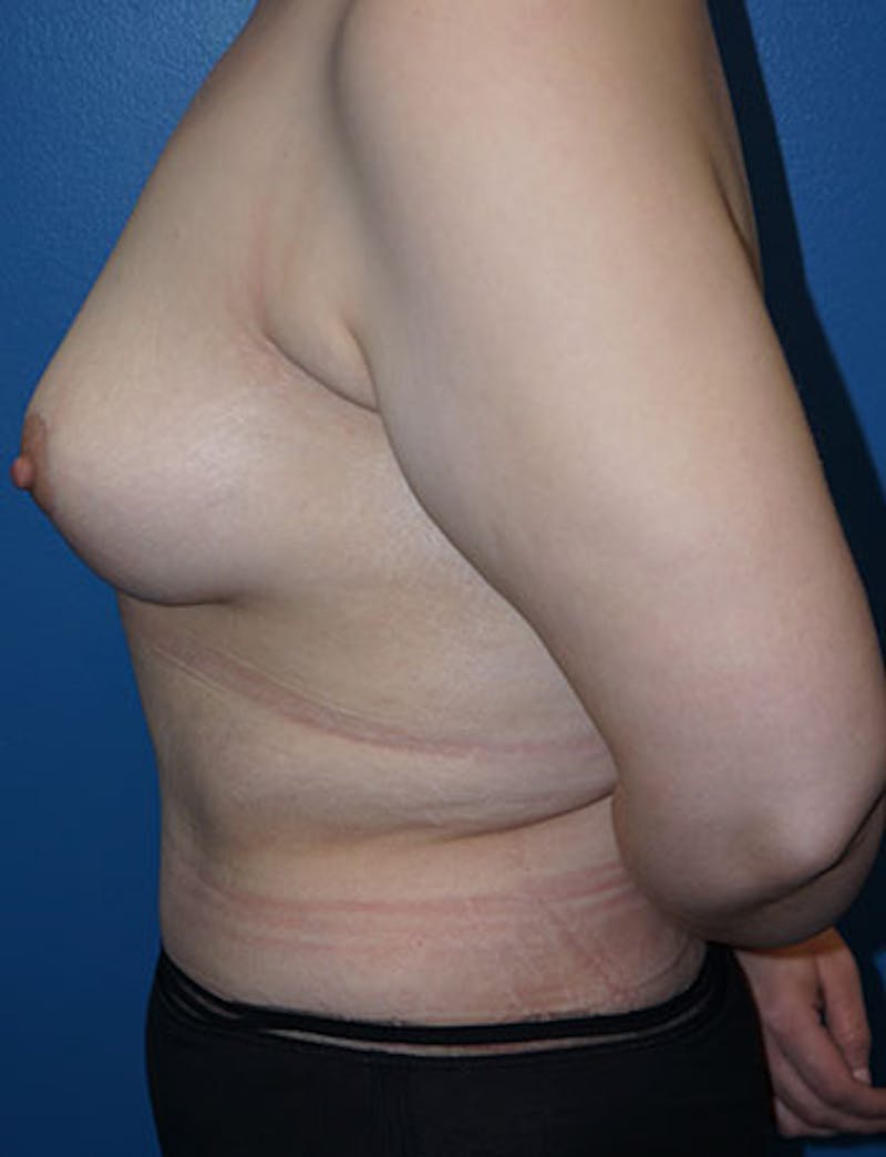 Tummy Tuck Before & After Gallery - Patient 93899234 - Image 6