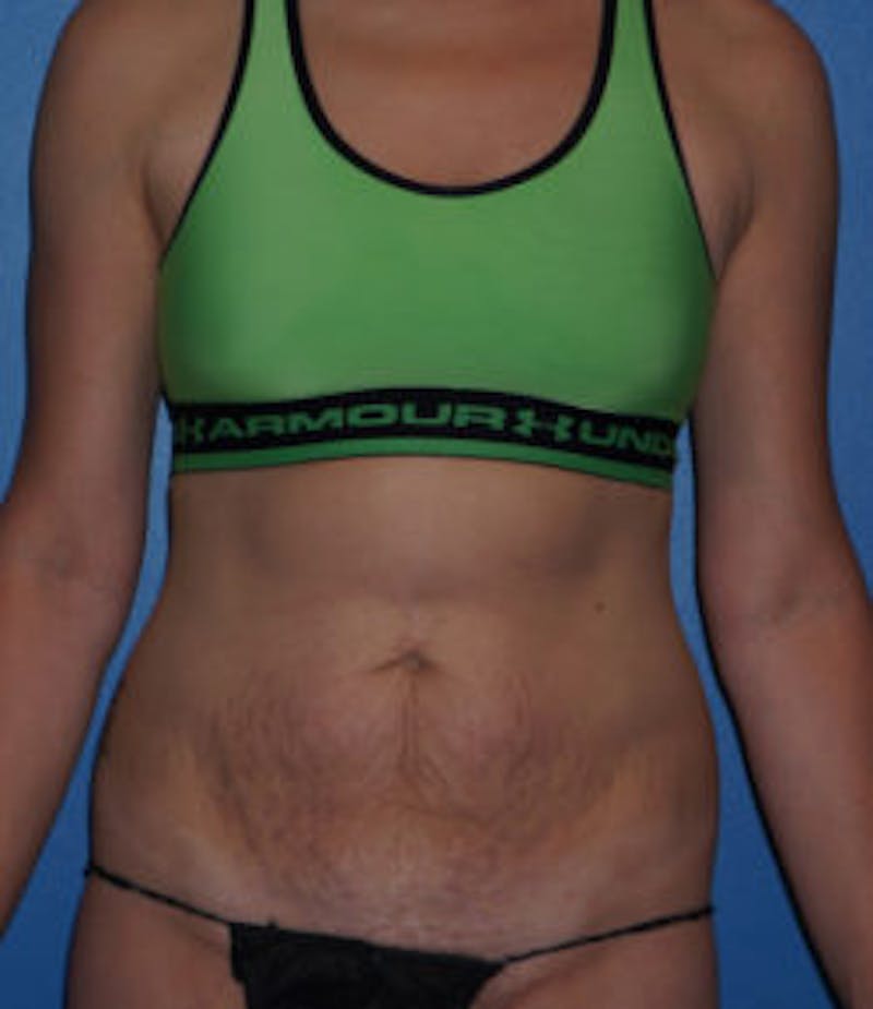 Tummy Tuck Before & After Gallery - Patient 93899263 - Image 1