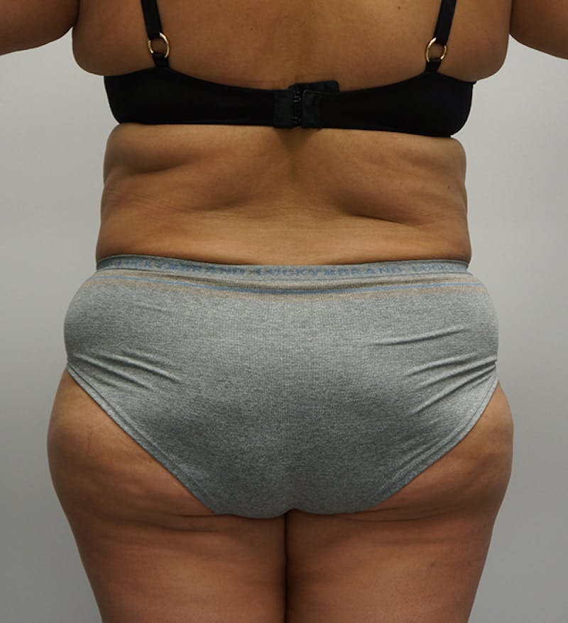 LPG Endermologie Before & After Gallery - Patient 93899264 - Image 1
