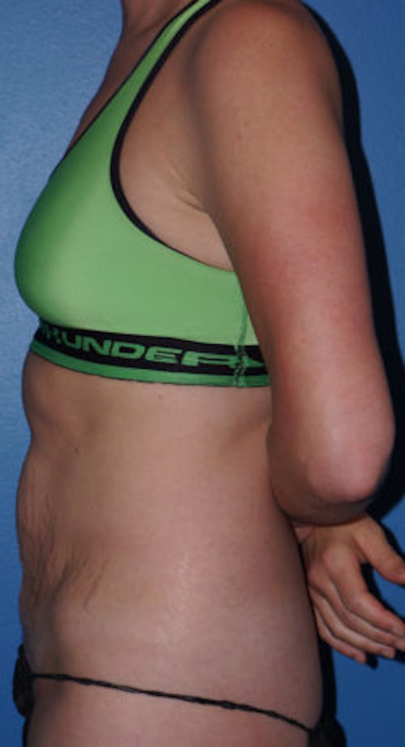 Tummy Tuck Before & After Gallery - Patient 93899263 - Image 3