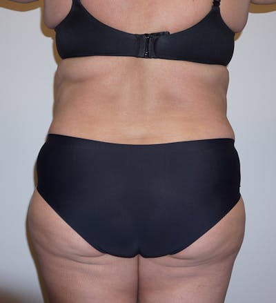 LPG Endermologie Before & After Gallery - Patient 93899264 - Image 2