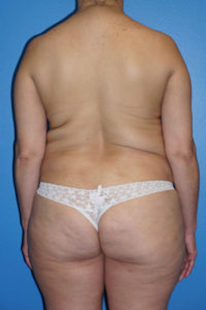 Tummy Tuck Before & After Gallery - Patient 93899311 - Image 5