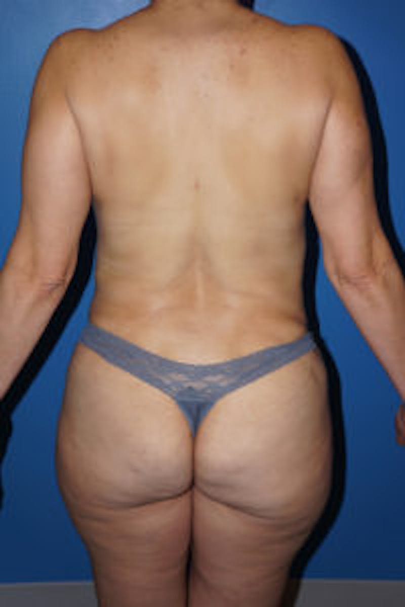 Tummy Tuck Before & After Gallery - Patient 93899311 - Image 6