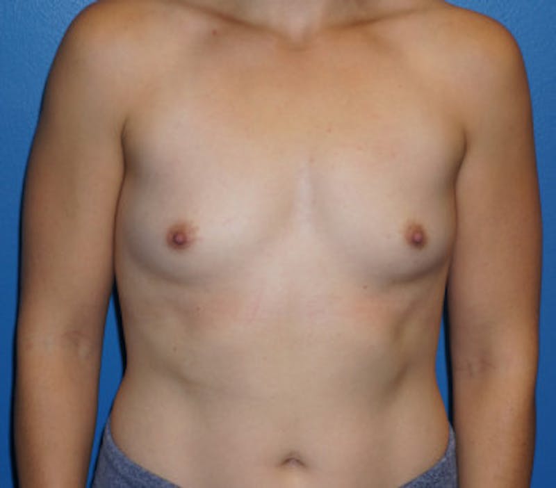 Breast Augmentation Before & After Gallery - Patient 93899344 - Image 1