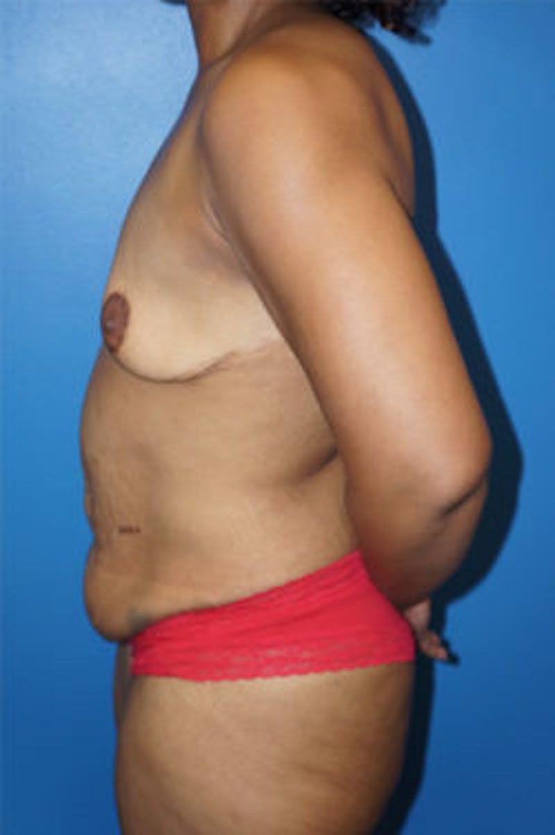 Tummy Tuck Before & After Gallery - Patient 93899330 - Image 3