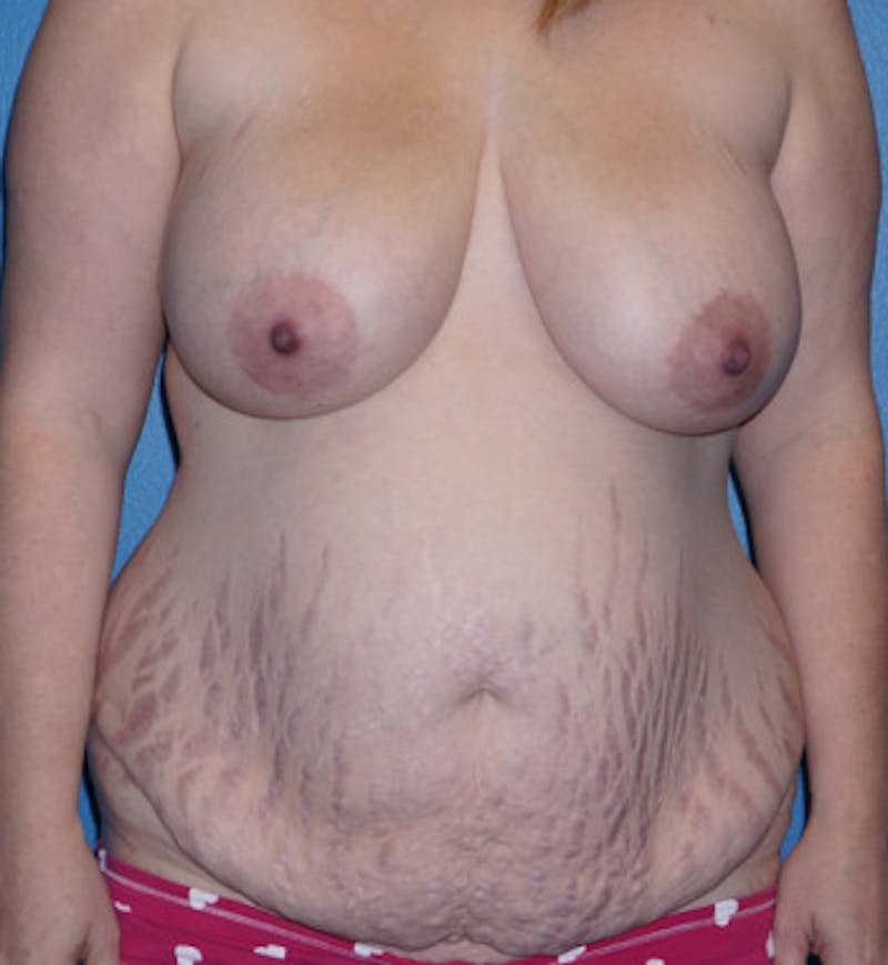 Tummy Tuck Before & After Gallery - Patient 93899347 - Image 1