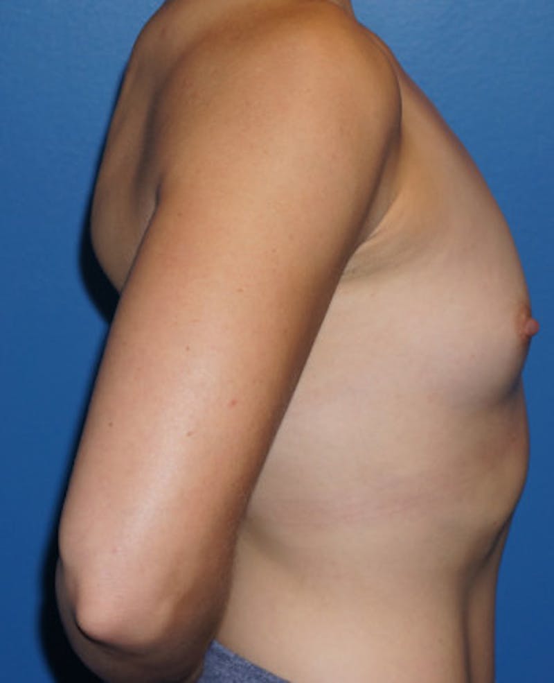 Breast Augmentation Before & After Gallery - Patient 93899344 - Image 5