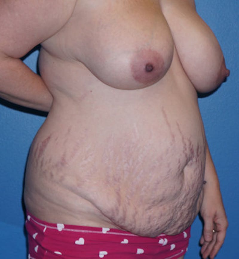 Tummy Tuck Before & After Gallery - Patient 93899347 - Image 3