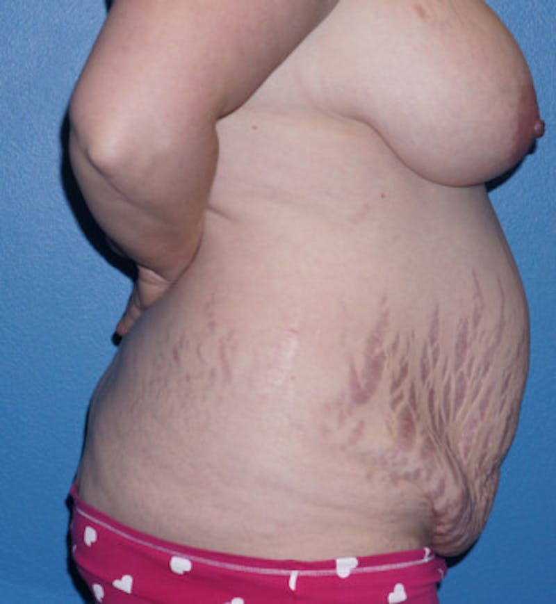 Tummy Tuck Before & After Gallery - Patient 93899347 - Image 5