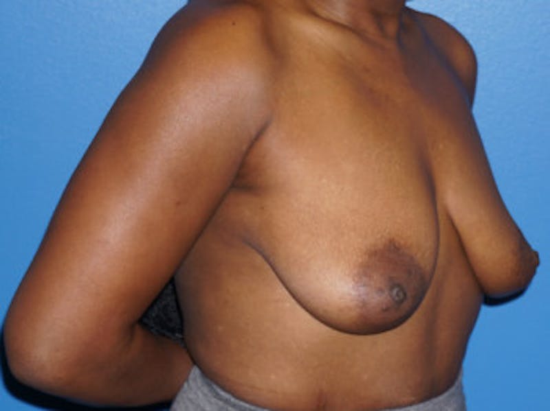 Breast Augmentation Before & After Gallery - Patient 93899350 - Image 3
