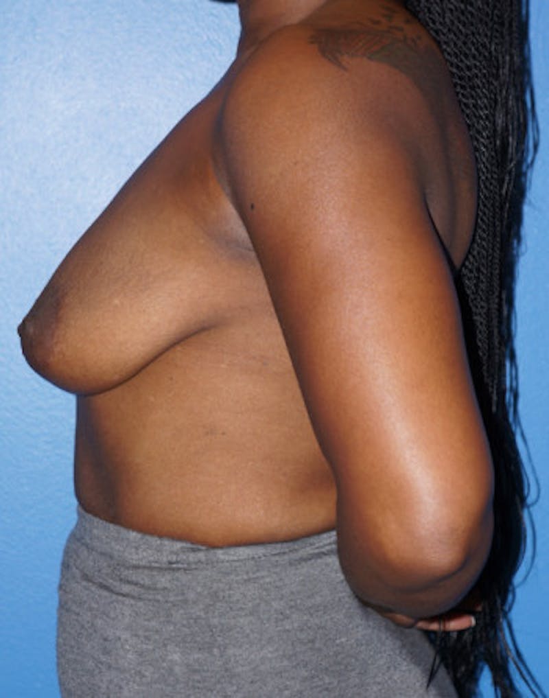 Breast Augmentation Before & After Gallery - Patient 93899350 - Image 5