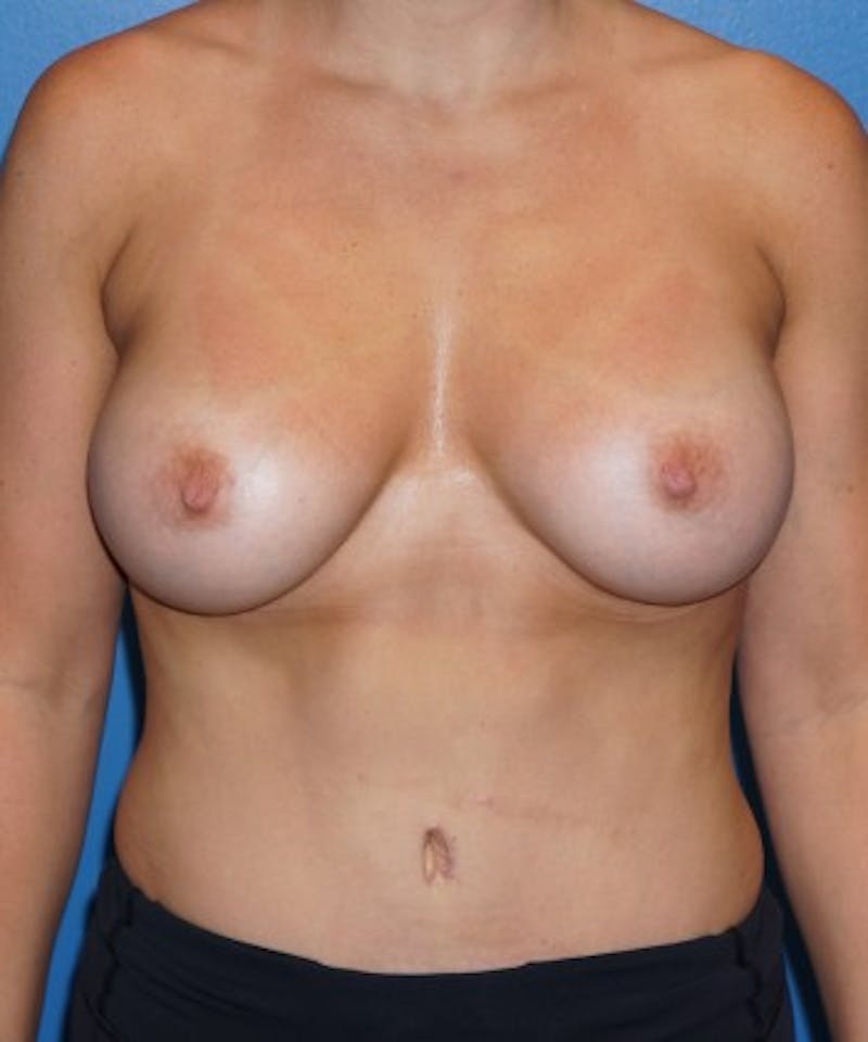 Tummy Tuck Before & After Gallery - Patient 93899377 - Image 2