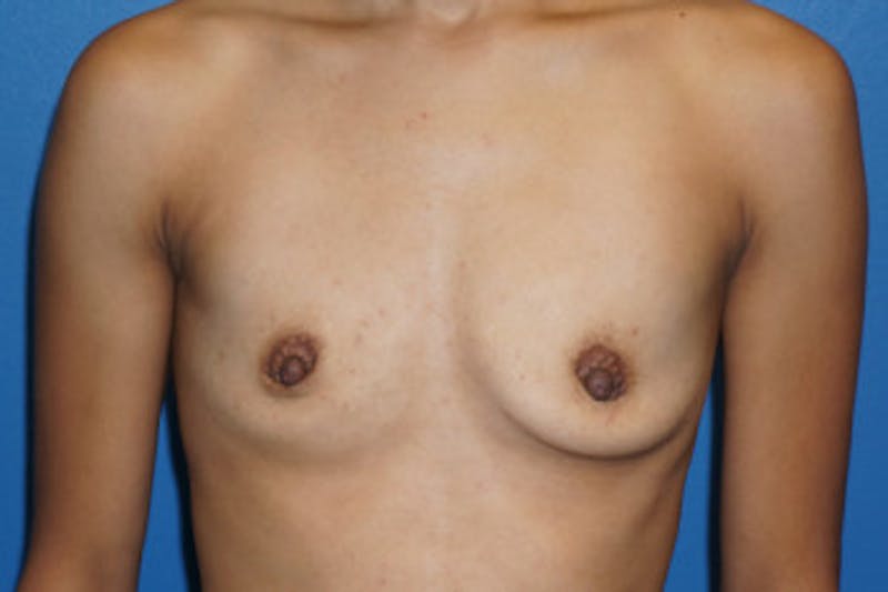 Breast Augmentation Before & After Gallery - Patient 93899378 - Image 1