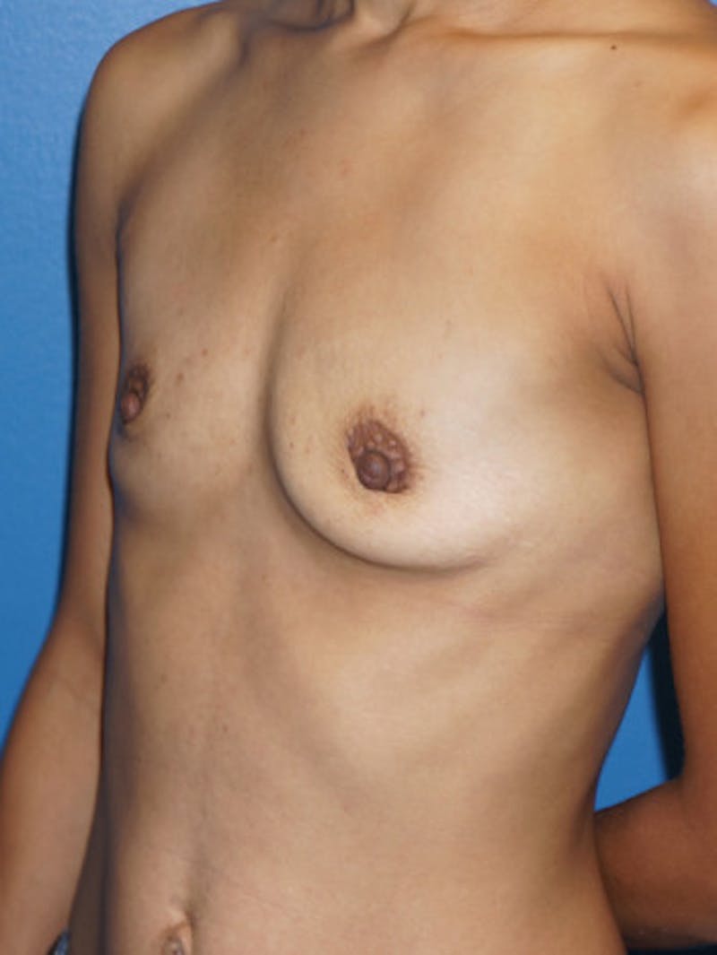 Breast Augmentation Before & After Gallery - Patient 93899378 - Image 3