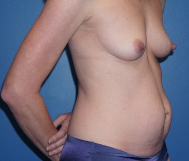Tummy Tuck Before & After Gallery - Patient 93899381 - Image 1