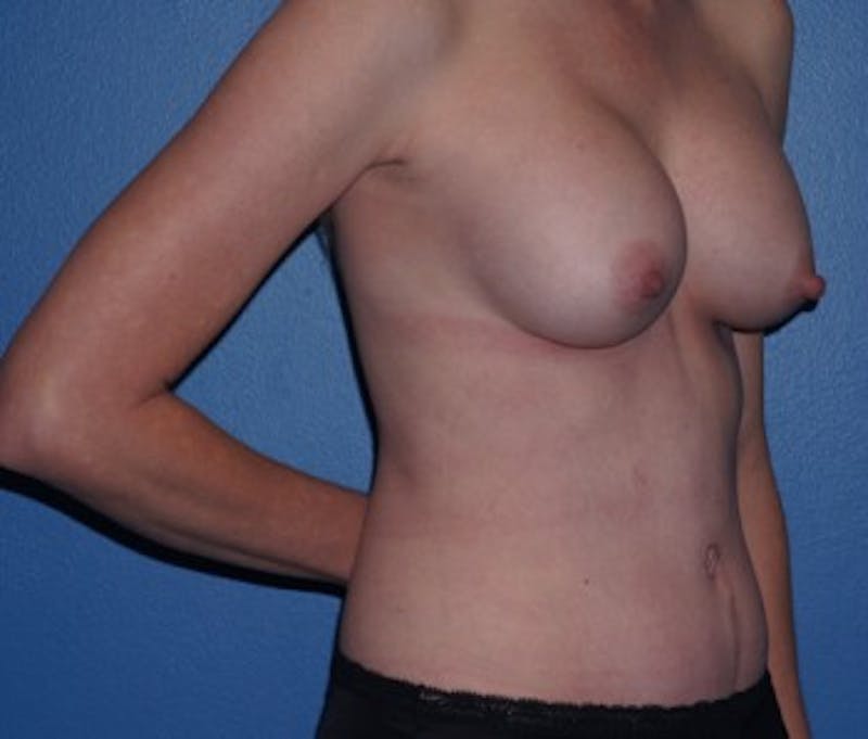 Tummy Tuck Before & After Gallery - Patient 93899381 - Image 2