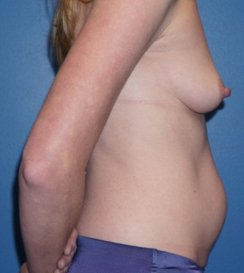 Tummy Tuck Before & After Gallery - Patient 93899381 - Image 3