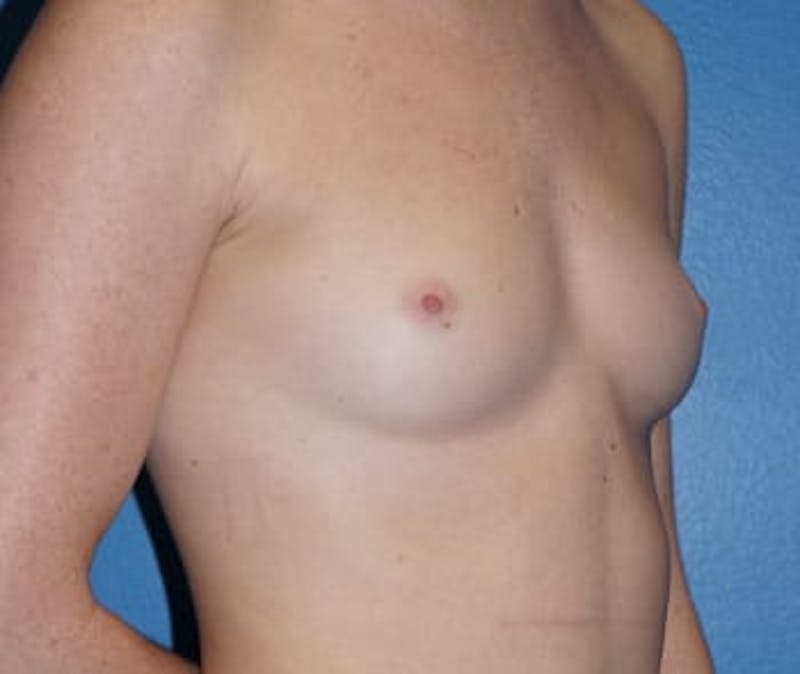 Breast Augmentation Before & After Gallery - Patient 93899386 - Image 1