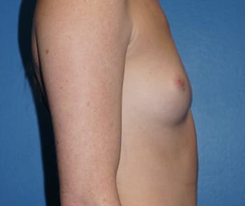 Breast Augmentation Before & After Gallery - Patient 93899386 - Image 3