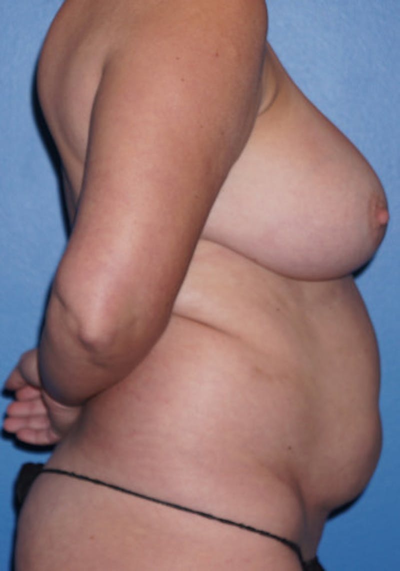 Tummy Tuck Before & After Gallery - Patient 93899403 - Image 1