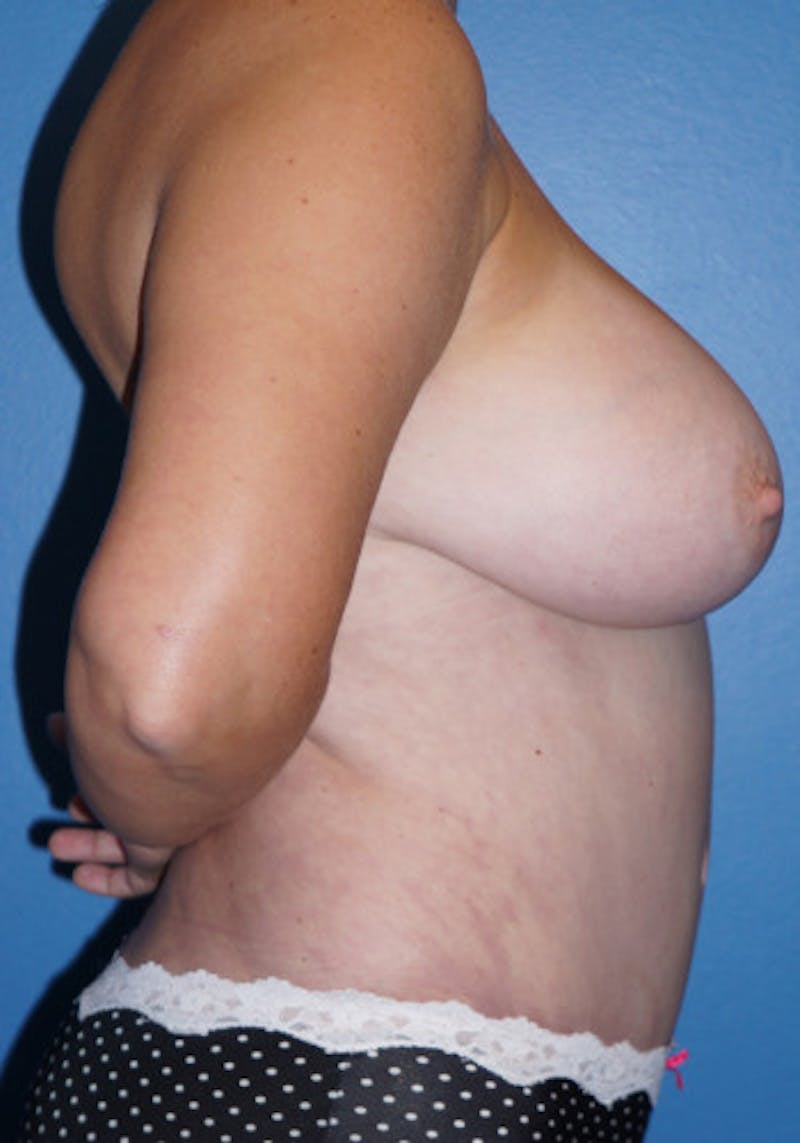 Tummy Tuck Before & After Gallery - Patient 93899403 - Image 2