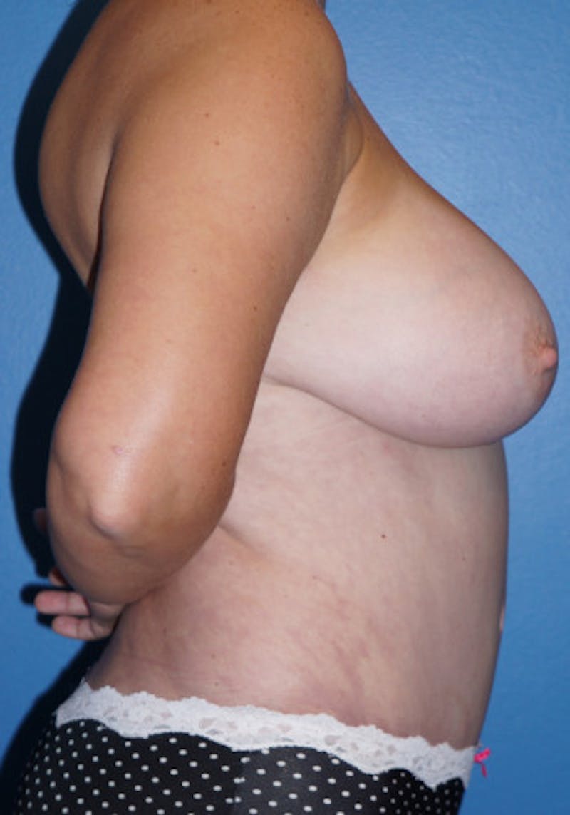 Tummy Tuck Before & After Gallery - Patient 93899403 - Image 2