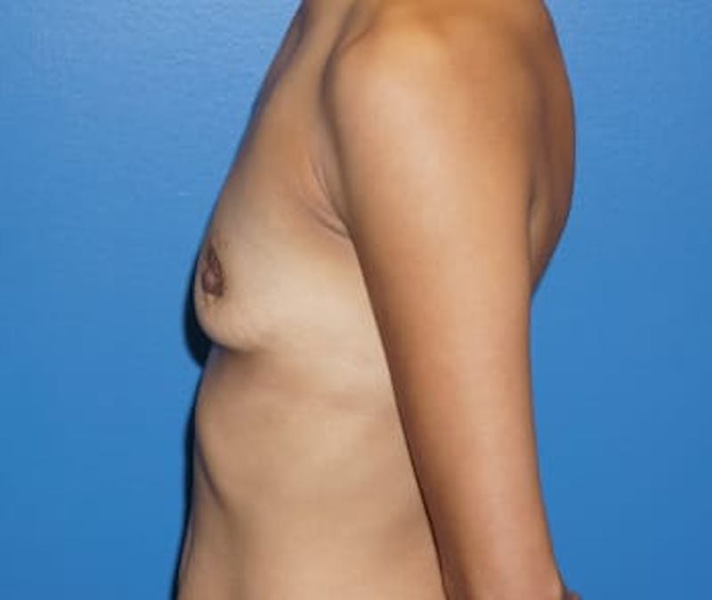Breast Augmentation Before & After Gallery - Patient 93899406 - Image 3