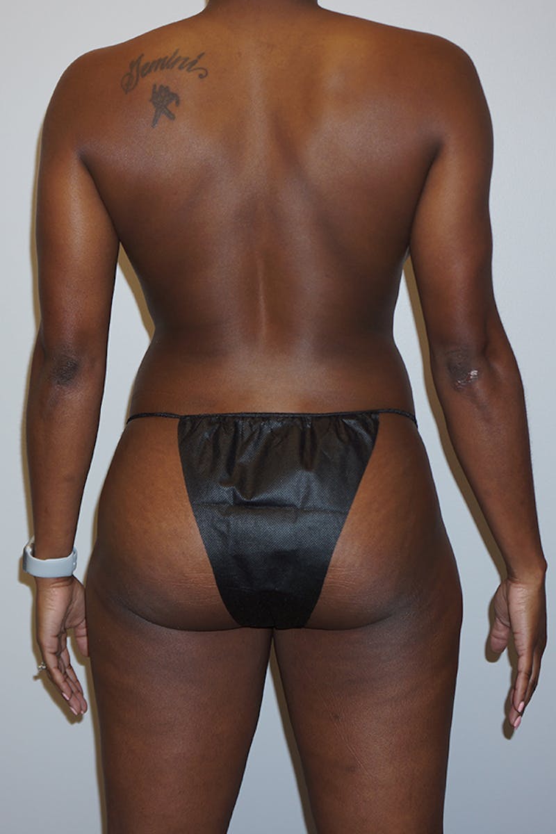 Tummy Tuck Before & After Gallery - Patient 93899424 - Image 3