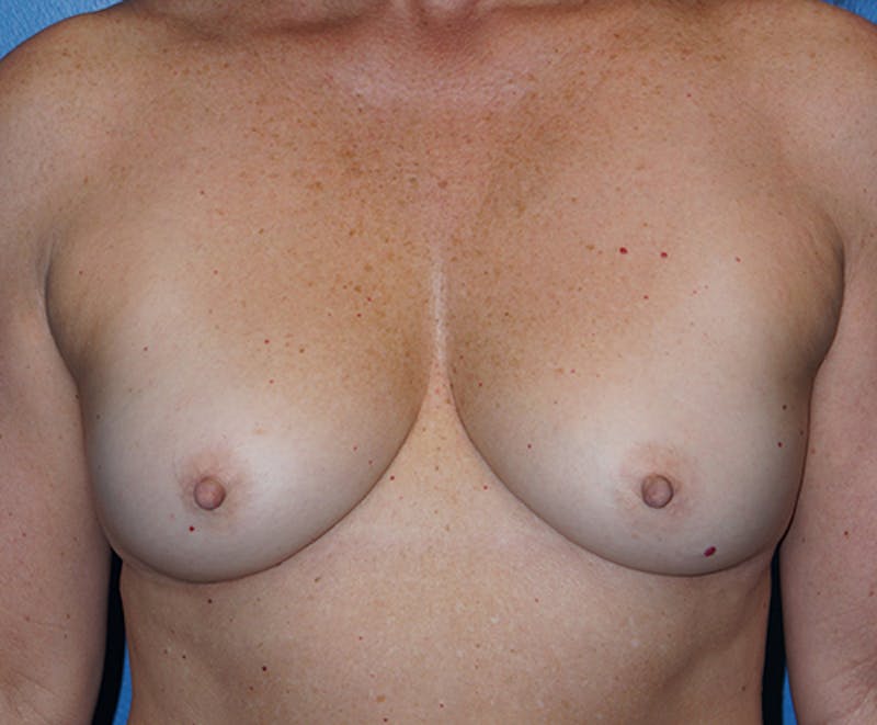 Breast Augmentation Before & After Gallery - Patient 93899466 - Image 1