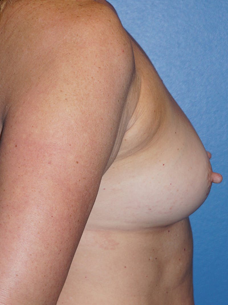 Breast Augmentation Before & After Gallery - Patient 93899466 - Image 5