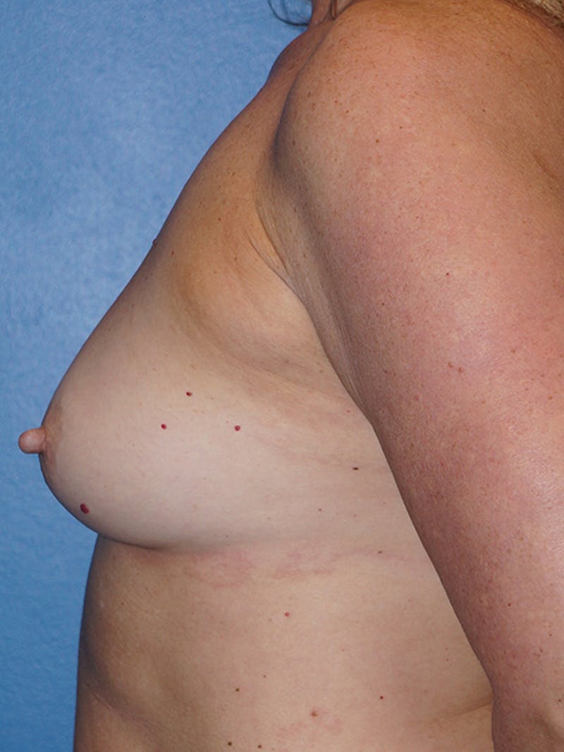Breast Augmentation Before & After Gallery - Patient 93899466 - Image 9