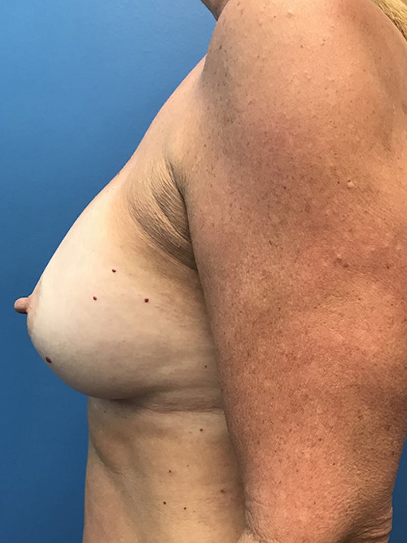 Breast Augmentation Before & After Gallery - Patient 93899466 - Image 10