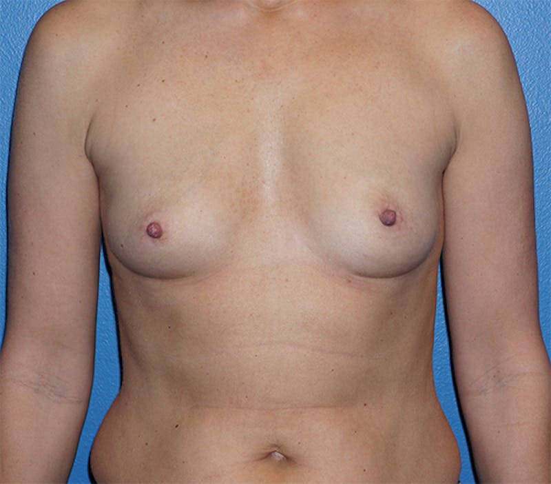 Breast Augmentation Before & After Gallery - Patient 93899516 - Image 1