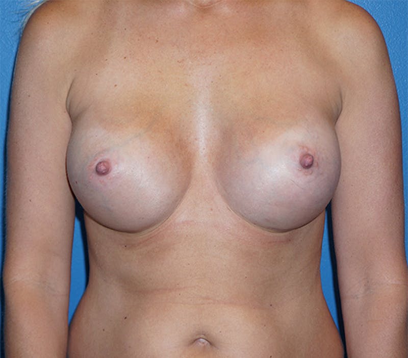 Breast Augmentation Before & After Gallery - Patient 93899516 - Image 2