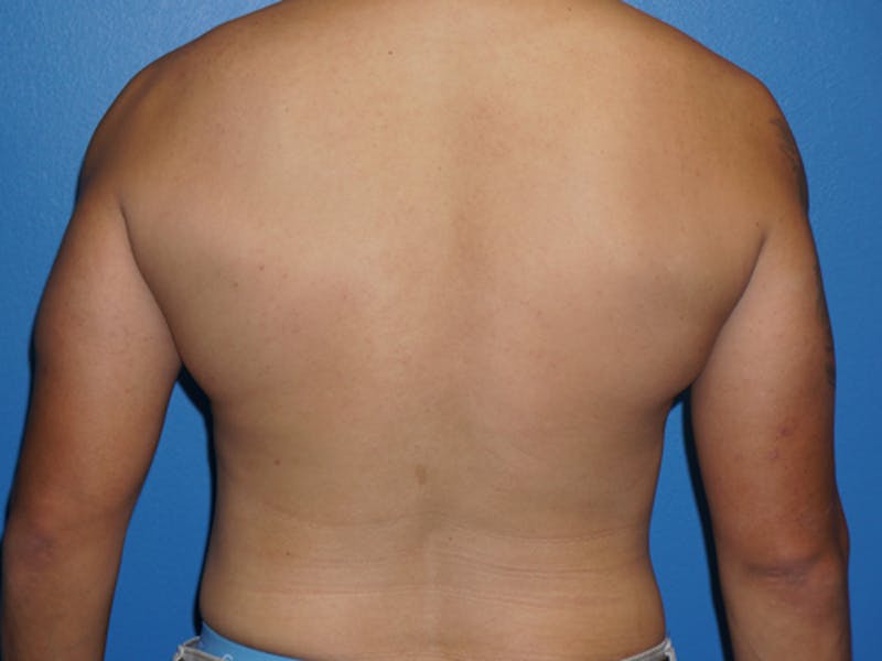 Liposuction Before & After Gallery - Patient 93899479 - Image 2